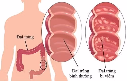 dau bung co phai la trieu chung cua viem dai trang co that hinh 1