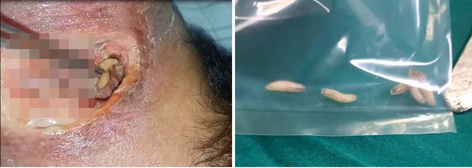 Rùng mình giòi bò lổn nhổn trong vết thương bị hoại tử của cụ ông 82 tuổi