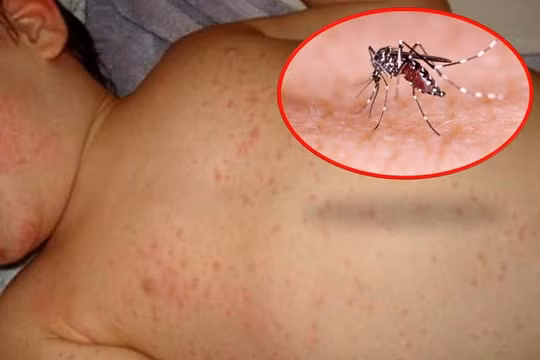 Cả nước đã có 50 ca tử vong vì sốt xuất huyết từ đầu năm