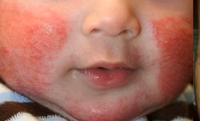 canh giac voi viem da co dia o tre mua hanh kho hinh 1