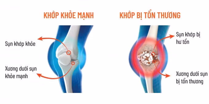 roi loan mien dich nguyen nhan goc re cua benh xuong khop hinh 2
