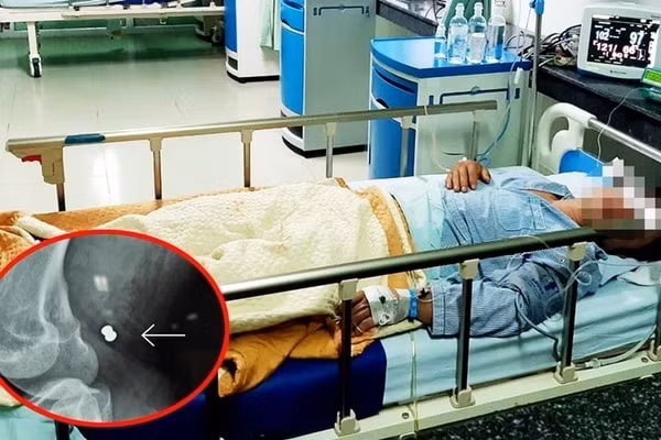 Anh H. bị thương phải nhập viện cấp cứu do trúng đạn súng bắn chim. Ảnh: vietnamnet.vn
