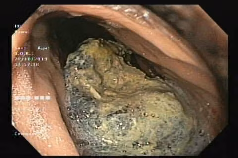 Bã thức ăn hồng giòn trong dạ dày bệnh nhân được các bác sĩ lấy ra ngoài.