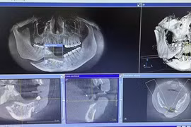 Cúi người vào thang máy đang sửa để nhặt điện thoại, người đàn ông bị vỡ nát xương hàm phải