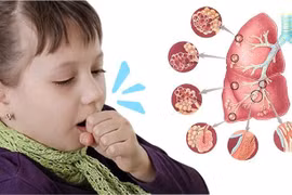 Hà Nội xuất hiện ca ho gà đầu tiên trong năm 2023: Khả năng lây lan cao, nhiều biến chứng nguy hiểm