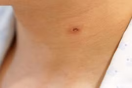 Người đàn ông bị suy thận cấp do ong vò vẽ đốt