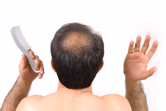 Chữa bệnh hói đầu bằng cách sử dụng da nhân tạo được “nuôi”