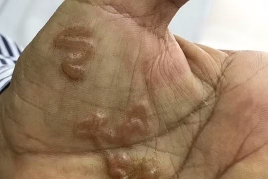 Nhiễm giun sán: Nguy cơ từ sinh hoạt, lối sống, không cẩn thận là ‘dính’ ngay