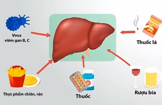 Men gan tăng cao - dấu hiệu cảnh báo ung thư gan