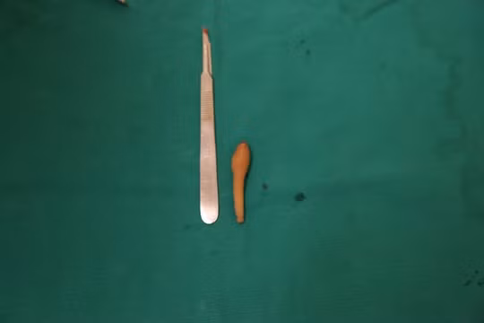 Hà Nội: Phẫu thuật thành công cho bé gái 5 tháng có 'đuôi' bẩm sinh dài 9,5cm