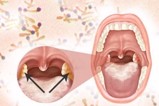 Cách nhận biết và phòng ngừa bệnh bạch hầu