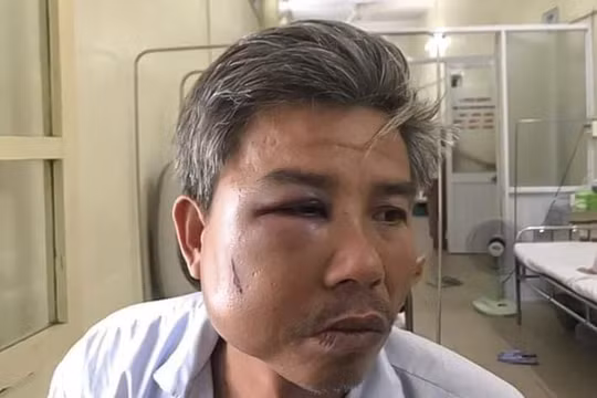 Thừa Thiên Huế: Khởi tố chủ quán cà phê đánh nhân viên Công ty cây xanh vỡ xương hàm