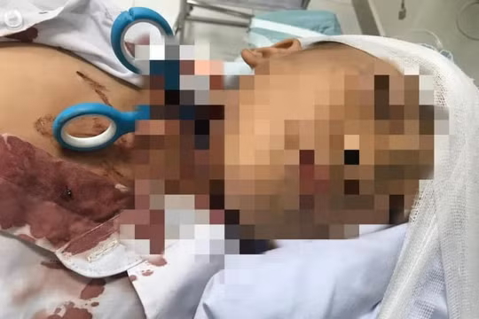 Cứu sống bé trai bị kéo đâm xuyên cổ