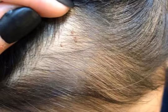 Trung Quốc: Giáo viên mầm non ngược đãi, đâm kim vào đầu và người trẻ