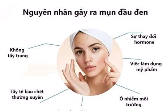 Cách trị mụn đầu đen tại nhà dễ dàng và hiệu quả nhất