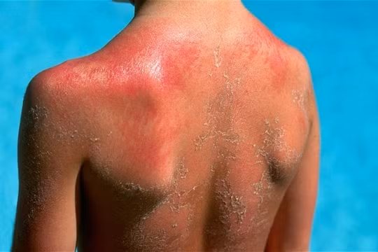 Mẹo phòng tránh bị tổn thương da khi đi nắng