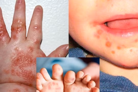 Phòng bệnh tay chân miệng: Cần chú ý điều gì ?