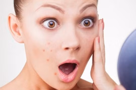 Những lưu ý khi trang điểm giúp bạn tránh bị nổi mụn