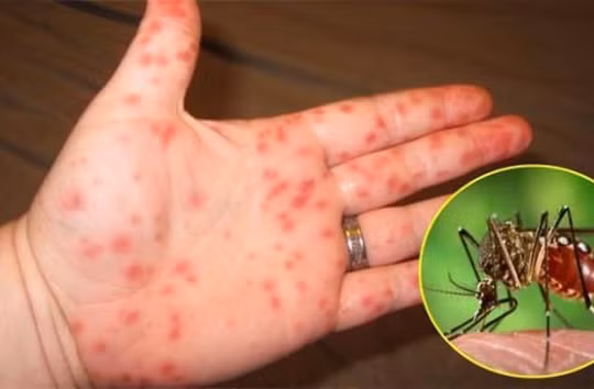CDC Đà Nẵng thông tin về bệnh nhân mắc virus Zika