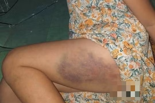 Đắk Lắk: Đình chỉ lên lớp một giáo viên đánh học sinh tím đùi