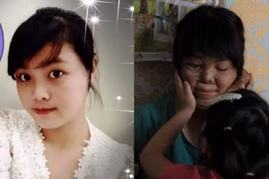 Cô gái bị chồng tưới xăng thiêu sống trải qua ca phẫu thuật thứ 17