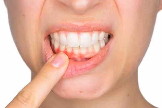 Những dấu hiệu bệnh răng miệng cho thấy sức khỏe bạn đang gặp vấn đề
