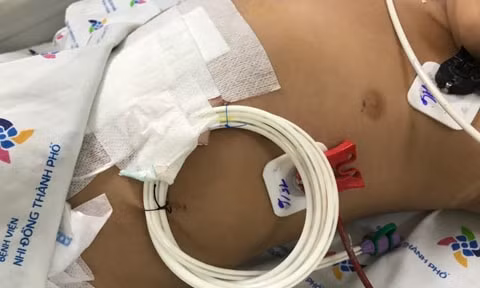 Bé trai 2 tuổi bỏng cổ họng do ống nhầm chai axit