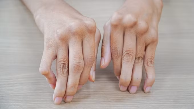 Đôi bàn tay co quắp do bệnh lý Viêm khớp dạng thấp, ngày càng tiến triển nặng, không chỉ hỏng mà các khớp bàn - ngón tay cũng bị trật dẫn đến các ngón tay của bệnh nhân vẹo sang một bên. Y văn gọi là bàn tay gió thổi và mu bàn tay hình lưng lạc đà.