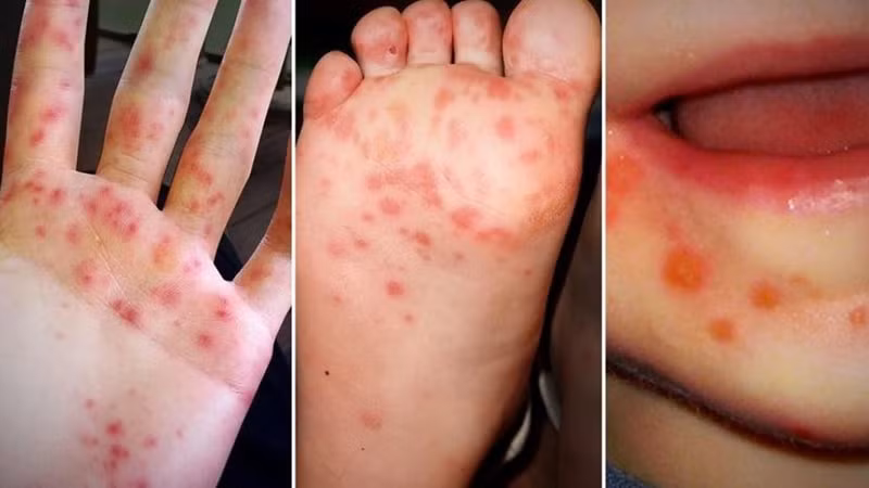 da co 21 truong hop tu vong tu dau nam do benh tay chan mieng hinh 1