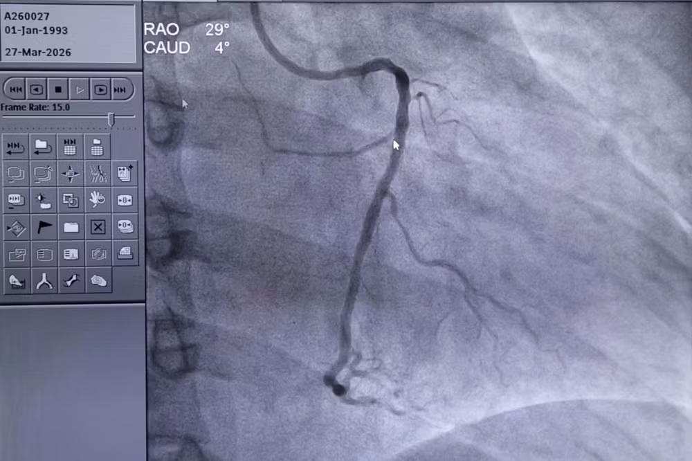Đoạn mạch vành phải đã được tái thông sau can thiệp đặt stent