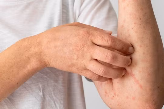 Nắng nóng gia tăng, người dân cần cẩn trọng với các bệnh ngoài da