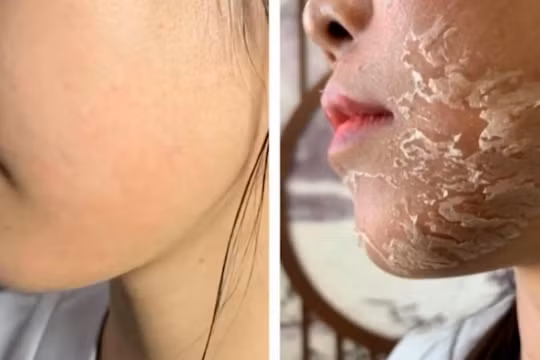 Làm đẹp cấp tốc, trả giá bằng tổn thương làn da