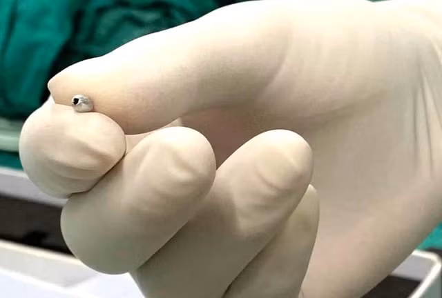 Hạt cườm sau đó được gắp ra ngoài. Ảnh: dantri.vn