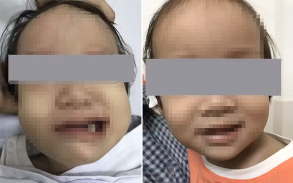 Hình ảnh bé B. đột ngột bị liệt mặt sau khi chảy mũi, ngạt mũi. Ảnh: tuoitre.vn