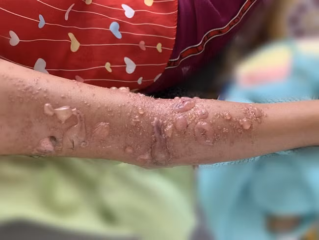 Cánh tay của bé gái phồng rộp sau khi bị sứa 'cắn'. Ảnh: TL.