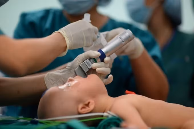 Hai bé được theo dõi sức khỏe liên tục suốt quá trình phẫu thuật. Ảnh: TL.