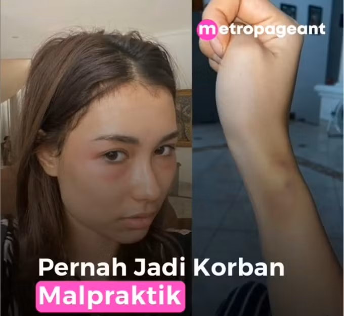Gương mặt sưng tấy của Frederika Alexis Cull sau vài lần làm da ở thẩm mỹ viện. Ảnh: Instagtam Metropageant.