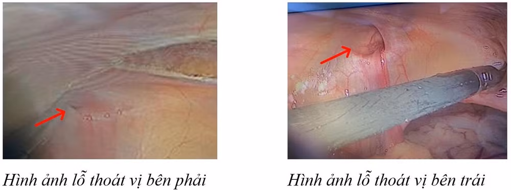 thoat vi ben nu gioi gap de roi vao truong hop bat thuong gioi tinh hinh 1