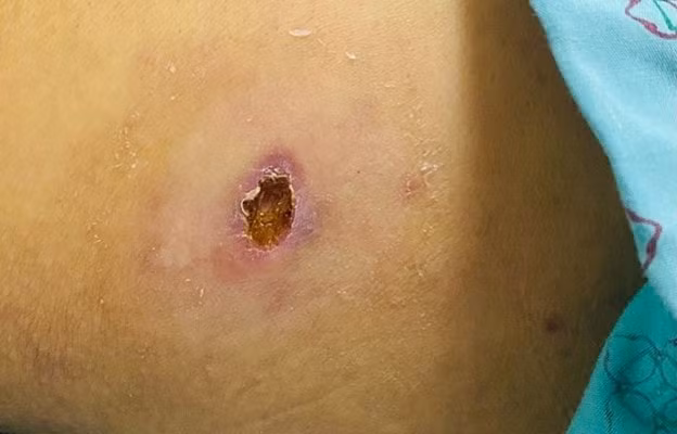 106 nguoi o yen bai bi sot mo mot nguoi tu vong do nhap vien muon hinh 1