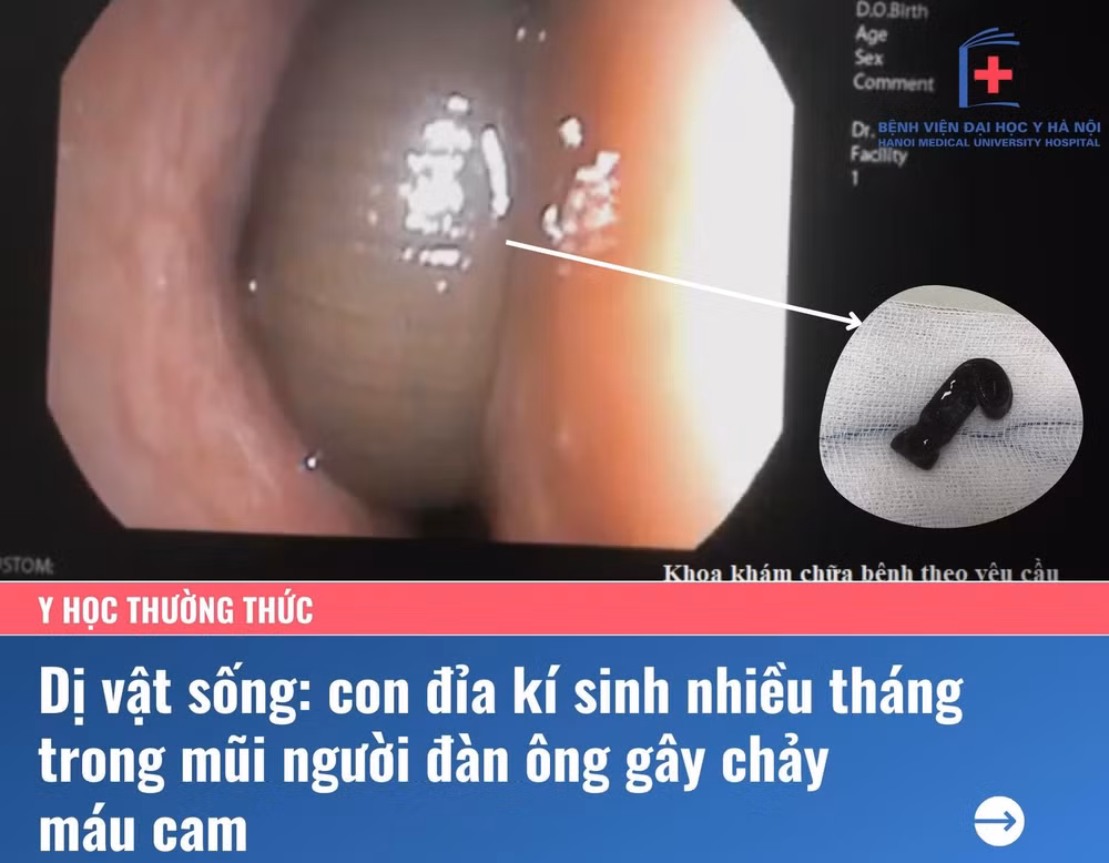 dia song trong mui hon 3 thang duoc chan doan viem xoang uong khang sinh keo dai hinh 1