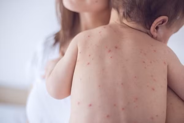 Hà Nội: Cảnh báo với hơn 1.000 ca mắc sởi và đang có chiều hướng gia tăng. Ảnh minh họa