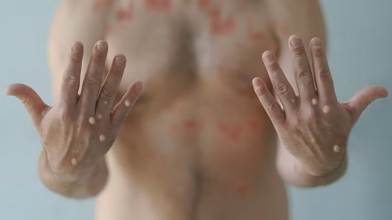 tp ho chi minh mot benh nhan nhiem hiv tu vong khi mac dau mua khi hinh 1
