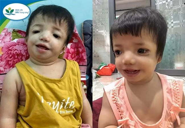 tai tao lai khuon mat cho benh nhi gap benh hiem hinh 1