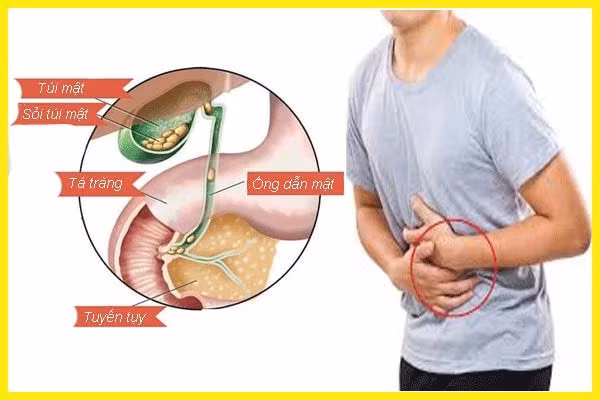 Sỏi mật là thủ phạm khiến đàn ông bị đau hạ sườn phải, vàng da. Ảnh minh họa.