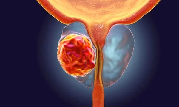 Khối u tuyến tiền liệt. Ảnh: Mayo Clinic