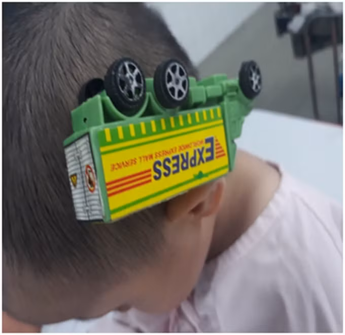 Do bất cẩn, bé trai bị xe đồ chơi cắm vào đầu. Ảnh: TL