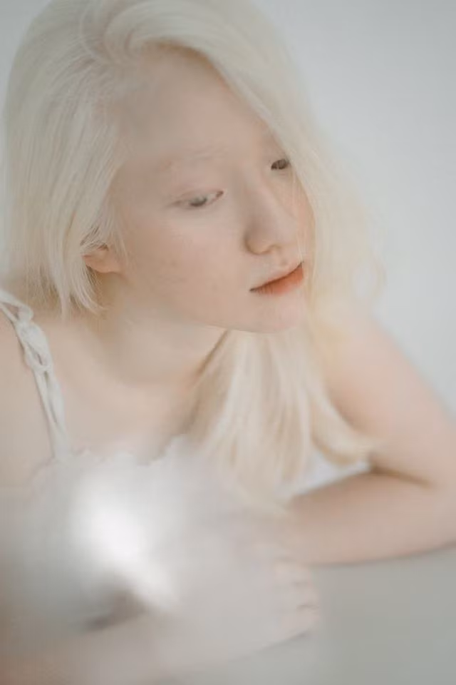 nữ sinh bạch tạng3