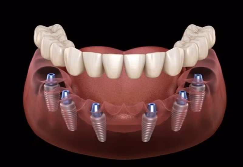 nsut chi trung trong rang implant uy tin chon nha khoa gia dinh hinh 4