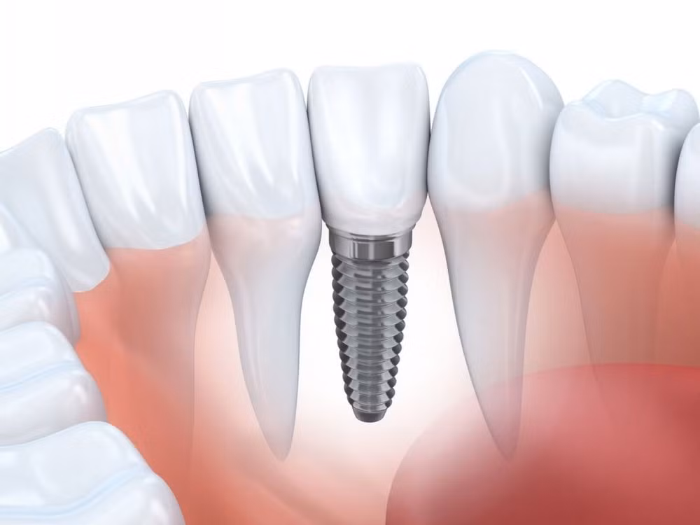 nsut chi trung trong rang implant uy tin chon nha khoa gia dinh hinh 2