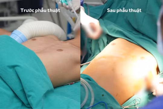 Vinmec Hải Phòng “hồi sinh” lồng ngực bị lõm cho cậu bé 13 tuổi bằng ca phẫu thuật tạo hình phức tạp